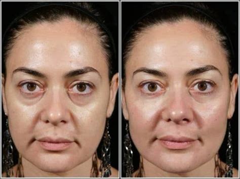 Plastic Surgery Bags Under Eyes Before After