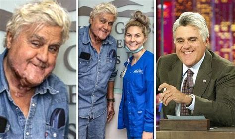 Jay Leno Pictured Leaving Hospital After Suffering Serious Burns