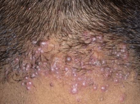 White bumps on skin, causes. Pimples on Back of Head Under Hair, Zits, Whiteheads ...