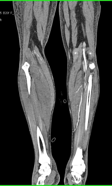 Myositis Right Calf With Compressed Vascular Flow Musculoskeletal