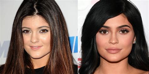 Plastic Surgery Before And After 9 Celebrities On What