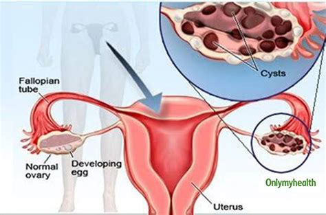 Ovarian Cyst Know The Types Causes Symptoms Treatment Risk Factors