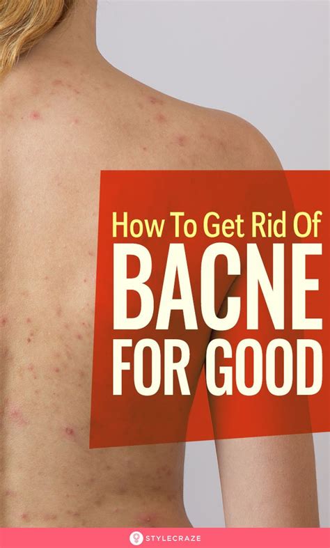 How To Get Rid Of Bacne For Good Bacne Back Facial Rid Bacne