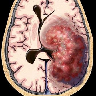 Forma irreversible de la pérdida de conciencia que se caracteriza por una desaparición completa de la función cerebral, con mantenimiento de la contracción cardiaca.3 gracias al avance tecnológico de la medicina, hoy es posible mantener una actividad cardiaca y. GLOSARIO 12 - Gamma Knife