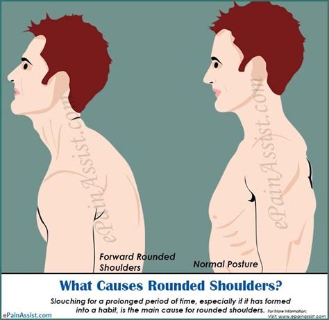 What Causes Rounded Shoulder And How To Get Rid Of It Rounded