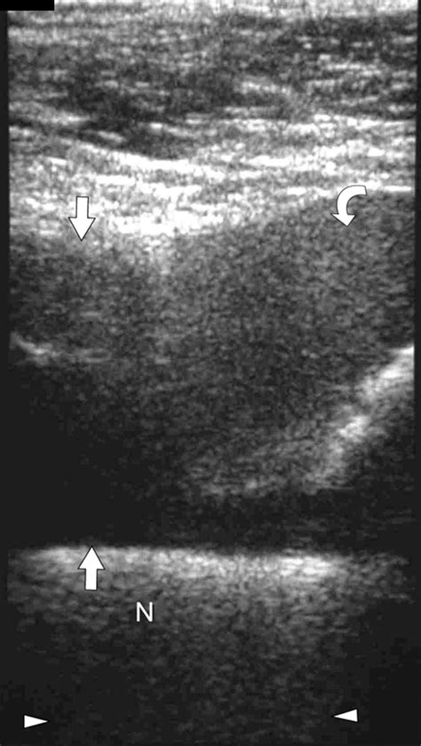 Limited Effectiveness Of Sonography In Revealing Hip Joint Effusion