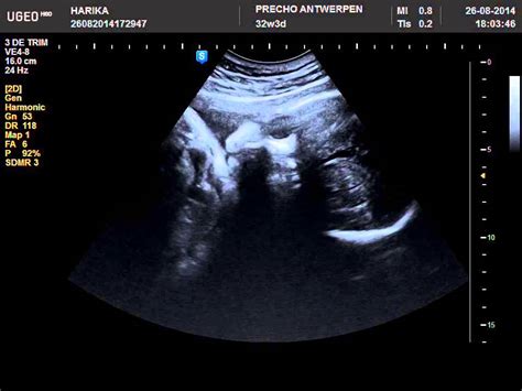 32 Weeks Pregnant 2d Ultrasound Baby Drinking Youtube