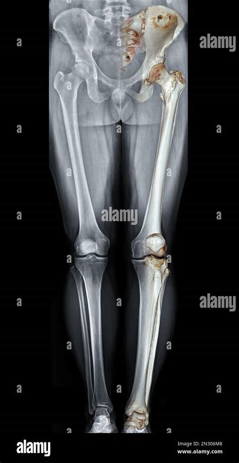 Knee Osteoarthritis 3d Scan Hi Res Stock Photography And Images Alamy