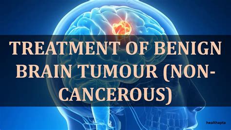 Treatment Of Benign Brain Tumour Non Cancerous Youtube