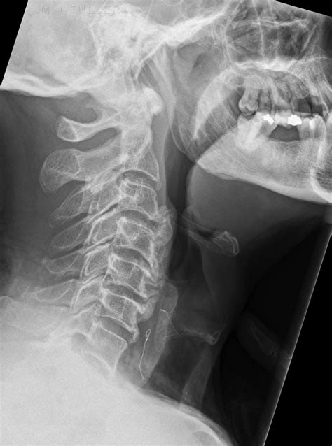 Lateral Soft Tissue Neck For Foreign Body Wikiradiography