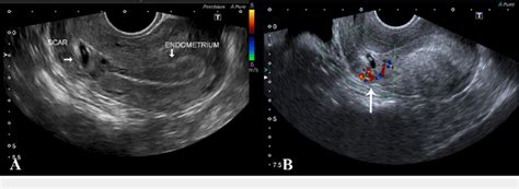 A Tvs Showing Retroverted Uterus With Empty Endometrial Cavity And