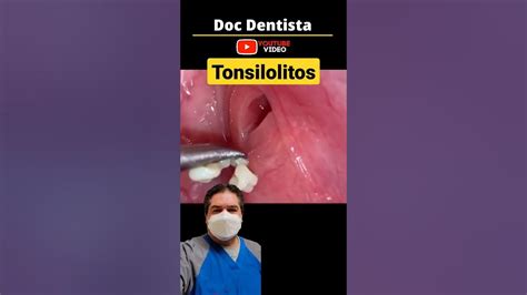 Tonsilolitos Bolitas Blancas Escondidas Dentro De Las Amígdalas Y