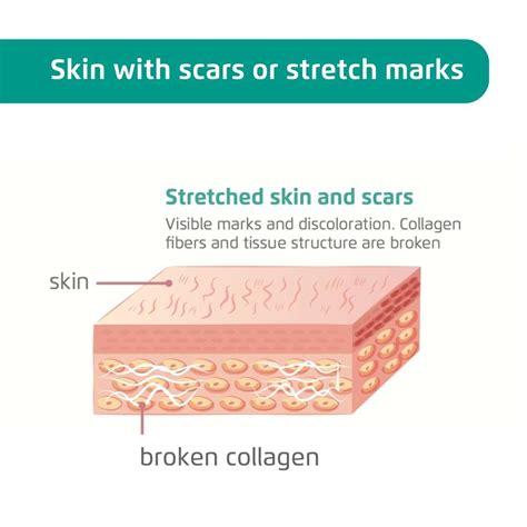 Skin Defects Mira Skin Eu