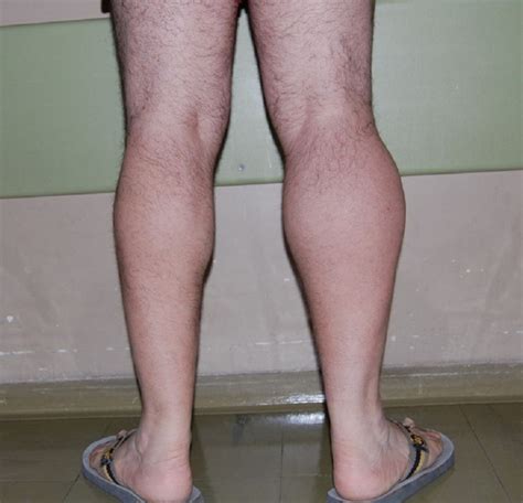 Unilateral Calf Hypertrophy And Radiculopathy An Unusual Association