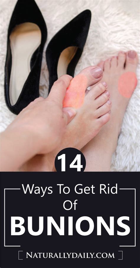 14 Sure Ways To Get Rid Of Bunions At Home Naturally Daily