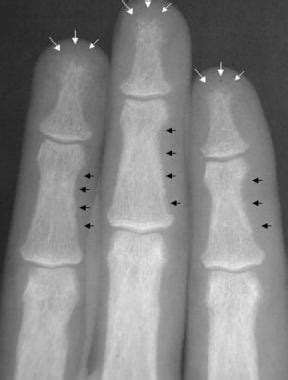 Imaging in Primary Hyperparathyroidism: Practice Essentials