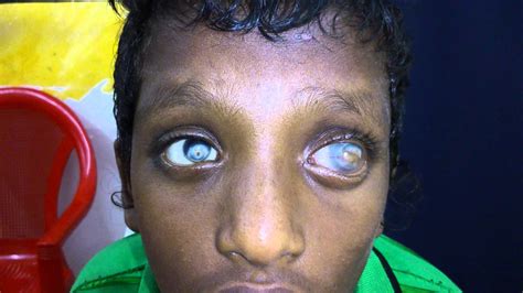 Xerophthalmia A Major Eye Problem Found In India Nutrilyf
