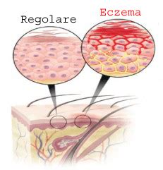 ECZEMA ATOPICO DEL CUOIO CAPELLUTO