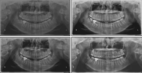 Uprighting Mesially Impacted Mandibular Molars With 2 Miniscrews