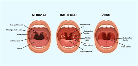 strep throat pictures in adults