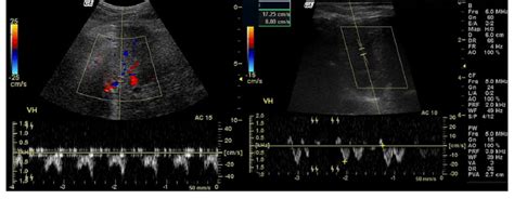 Pulsed Doppler Sonographic Images Show Biphasic Morphology Of The