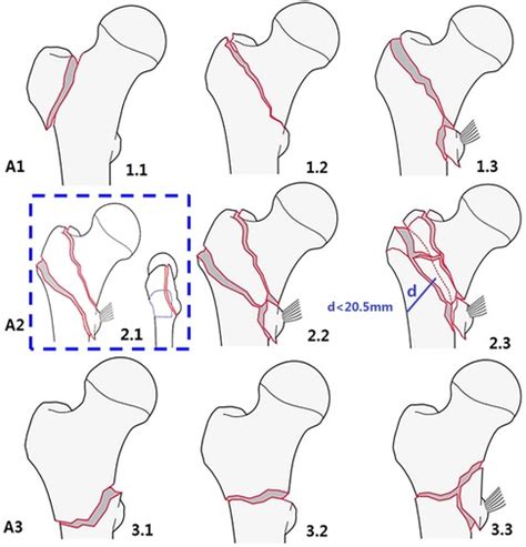 Frontiers A Sophisticated Fracture Classification System Of The