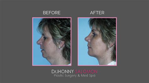 Treating The Double Chin From Least Invasive To Most Invasive