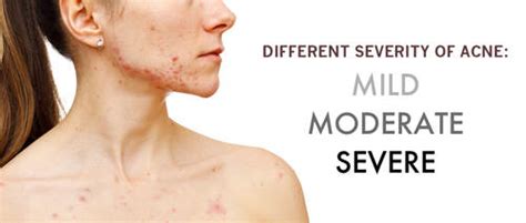 Learn About The Different Types Of Acne Toronto Dermatology Centre