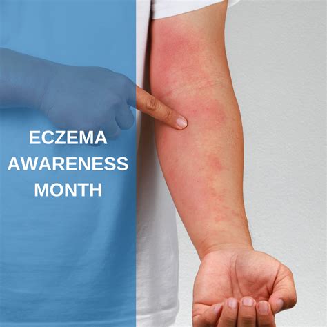 Eczema Awareness Month Savannah River Dermatology