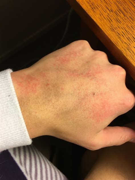Any Advice Been On Accutane For 3 Weeks Now And Noticed These Red