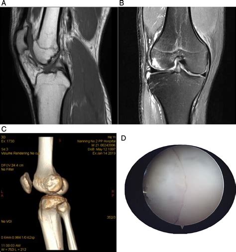 Treatment Of Osteochondral Fracture Of The Lateral Femoral Condyle With Twinfix Ti Suture Anchor