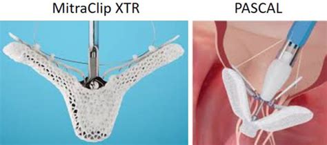 Mitraclip Xtr Vs Pascal Transcatheter Valve Repair System For Edge To