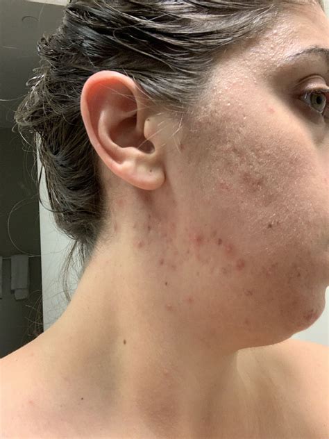 31 Year Old Female Bacterial Acne Or Fungal Pictures General