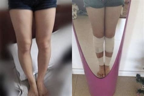 A Girl Undergoes Leg Lengthening Surgery To Grow 10cm Heres The Before And After Results