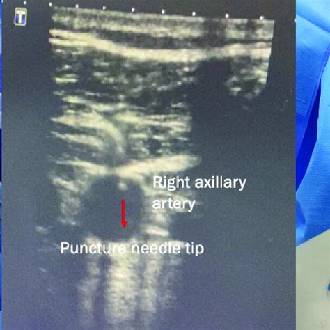 Ultrasound Guided Right Axillary Artery Puncture And Download