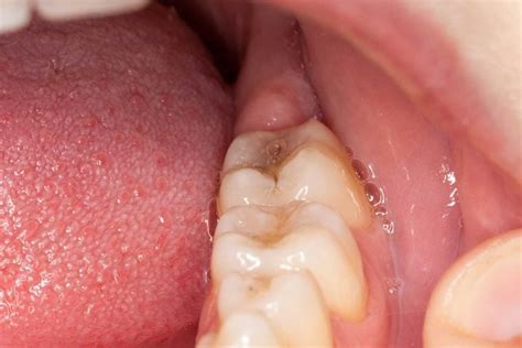 Cavity Symptoms You Shouldnt Ignore The Healthy