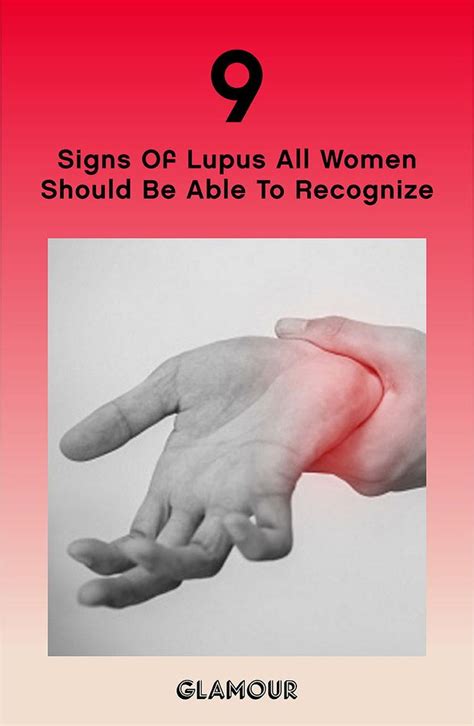 9 Signs Of Lupus All Women Should Be Able To Recognize Lupus Acne