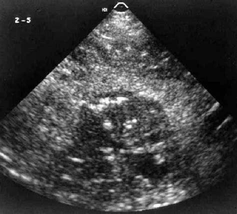 Ultrasound Examination Of Prostate Carcinoma In A Dog Note The