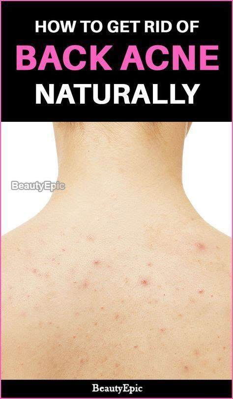 How To Get Rid Of Back Acne Naturally Back Acne Treatment Acne
