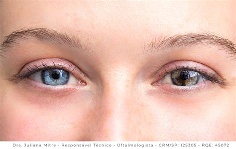Heterocromia Por Que Algumas Pessoas Têm Os Olhos De Cores Diferentes