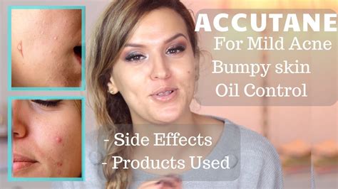 ACCUTANE ROACCUTANE FOR MILD ACNE OILY SKIN AND STUBBORN SKIN BUMPS LOW DOSE Mg SIDE