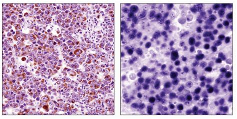 Plasmablastic Lymphoma Arising In Hhv8 Multicentric Castleman Disease