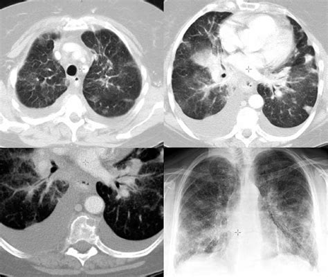 The presence of multiple hamartomas in the lungs. Sammlung Radiologie der Lungentumoren