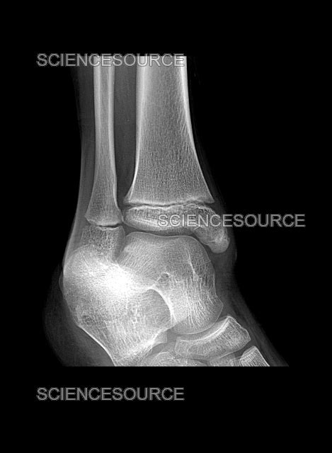 Pediatric Ankle X Ray Stock Image Science Source Images