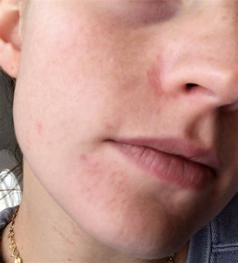 I Started Getting Perioral Dermatitis Heres How I Am Treating It