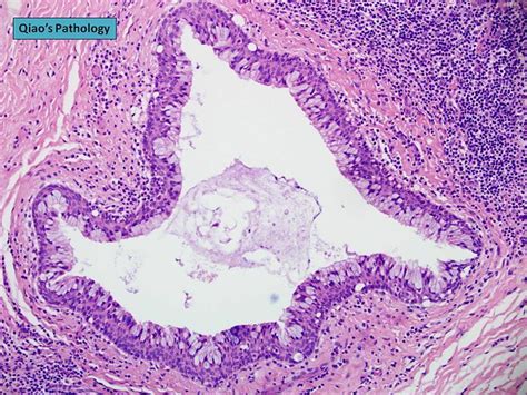 Qiaos Pathology Preauricular First Branchial Cleft Cyst Flickr