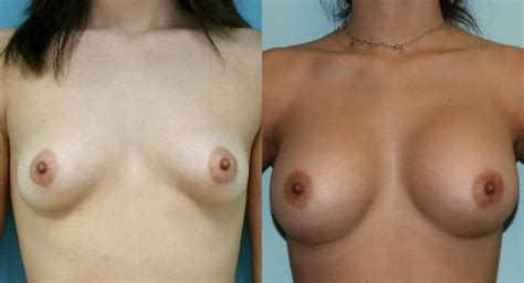 Breast Augmentation Photos Chevy Chase Md Patient
