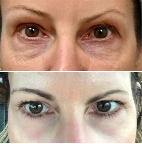 Agnes Radiofrequency Microneedling Facial Contouring Milwaukee Wi