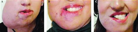 A Soft Tender Pulsatile Swelling In Right Mandibular Region And