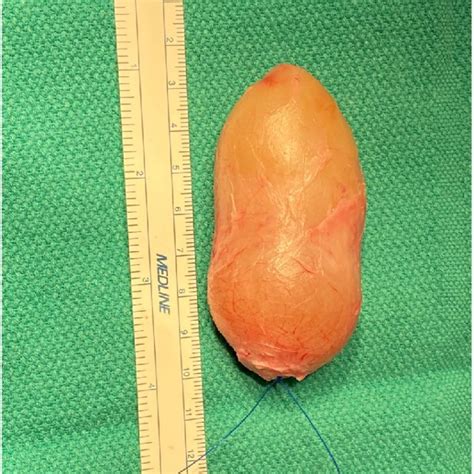 Intact Cyst Post Excision From Skin And Corpus Spongiosum Download